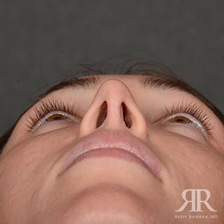 Female Rhinoplasty Before & After Gallery - Patient 622061 - Image 8