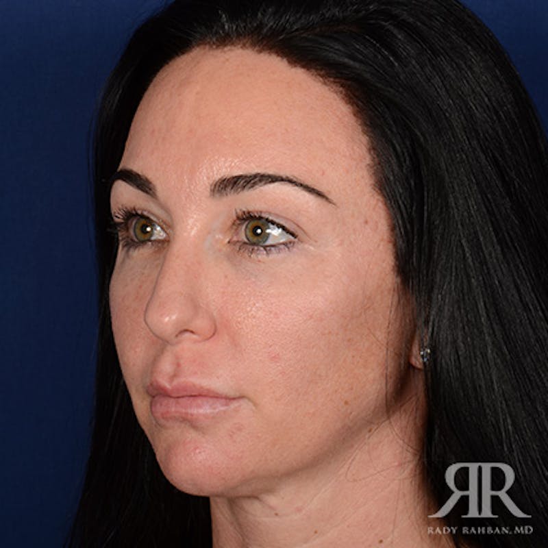 Female Rhinoplasty Before & After Gallery - Patient 255539 - Image 3