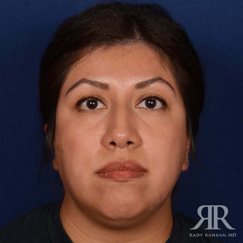 Female Rhinoplasty Before & After Gallery - Patient 394425 - Image 1