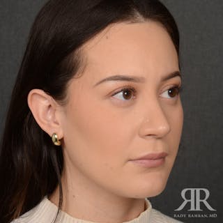 Female Rhinoplasty Before & After Gallery - Patient 302916 - Image 4