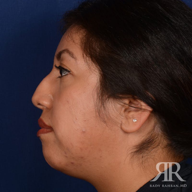Female Rhinoplasty Before & After Gallery - Patient 394425 - Image 5