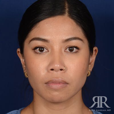 Female Rhinoplasty Before & After Gallery - Patient 428301 - Image 1