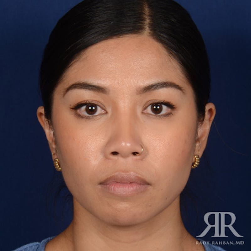Female Rhinoplasty Before & After Gallery - Patient 428301 - Image 1