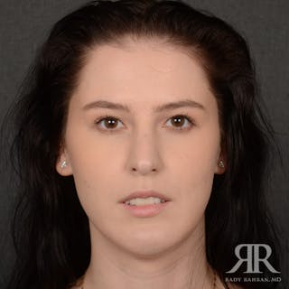 Female Rhinoplasty Before & After Gallery - Patient 342016 - Image 2