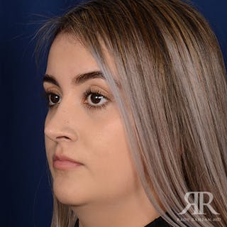 Female Rhinoplasty Before & After Gallery - Patient 277145 - Image 4