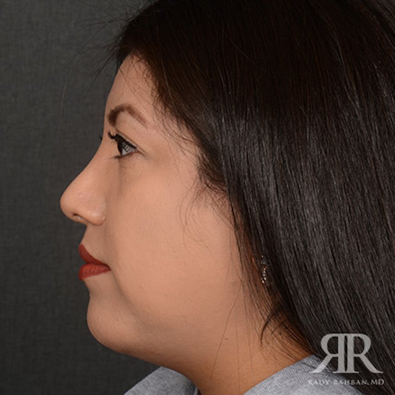 Female Rhinoplasty Before & After Gallery - Patient 394425 - Image 6