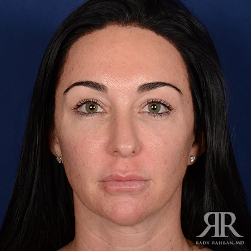 Female Rhinoplasty Before & After Gallery - Patient 255539 - Image 1