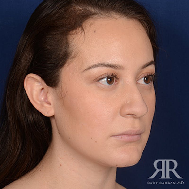 Female Rhinoplasty Before & After Gallery - Patient 302916 - Image 3