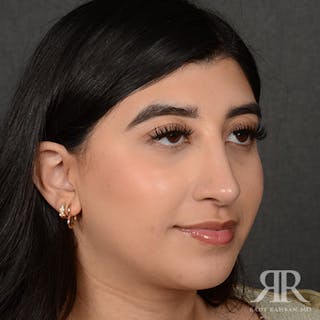 Female Rhinoplasty Before & After Gallery - Patient 187268 - Image 4