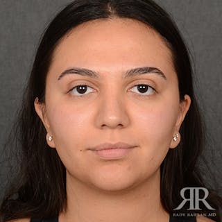 Female Rhinoplasty Before & After Gallery - Patient 287540 - Image 2