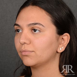 Female Rhinoplasty Before & After Gallery - Patient 287540 - Image 4