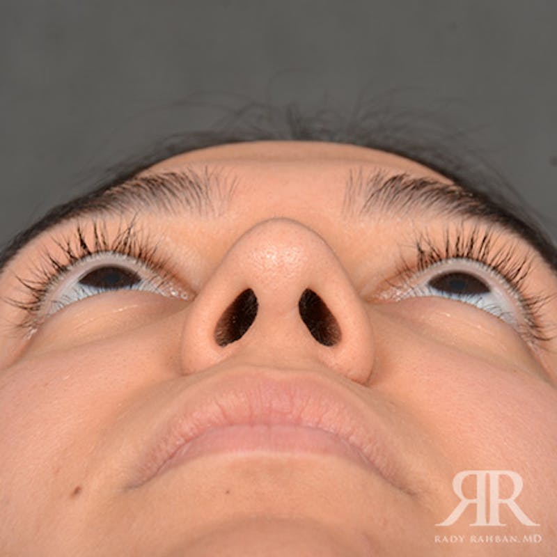 Female Rhinoplasty Before & After Gallery - Patient 287540 - Image 8