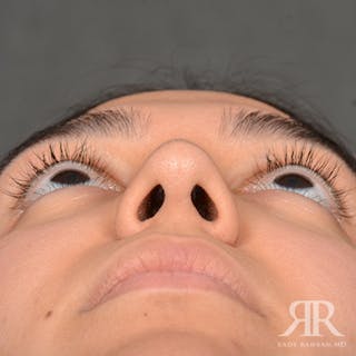 Female Rhinoplasty Before & After Gallery - Patient 287540 - Image 8