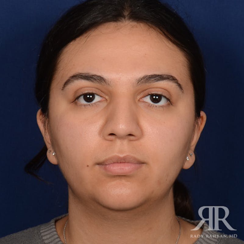 Female Rhinoplasty Before & After Gallery - Patient 287540 - Image 1