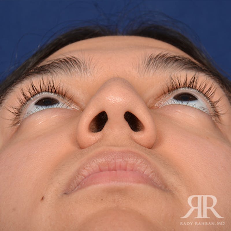 Female Rhinoplasty Before & After Gallery - Patient 287540 - Image 7