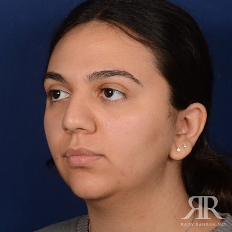 Female Rhinoplasty Before & After Gallery - Patient 287540 - Image 3