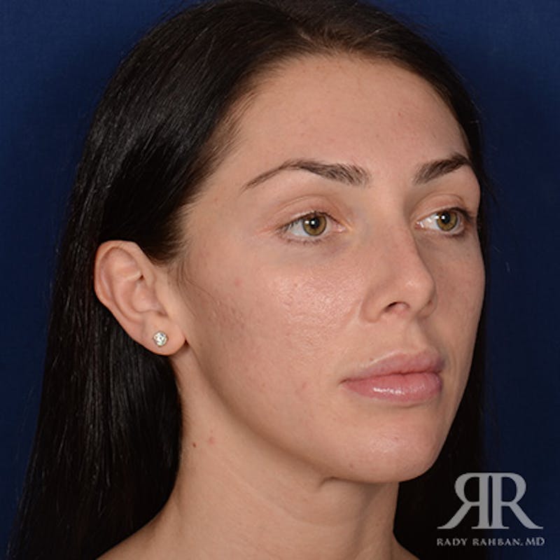 Female Rhinoplasty Before & After Gallery - Patient 622061 - Image 3