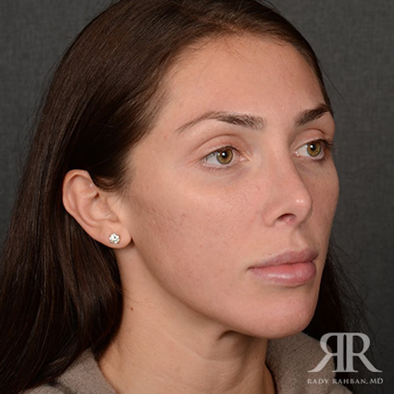 Female Rhinoplasty Before & After Gallery - Patient 622061 - Image 4