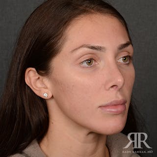 Female Rhinoplasty Before & After Gallery - Patient 622061 - Image 4