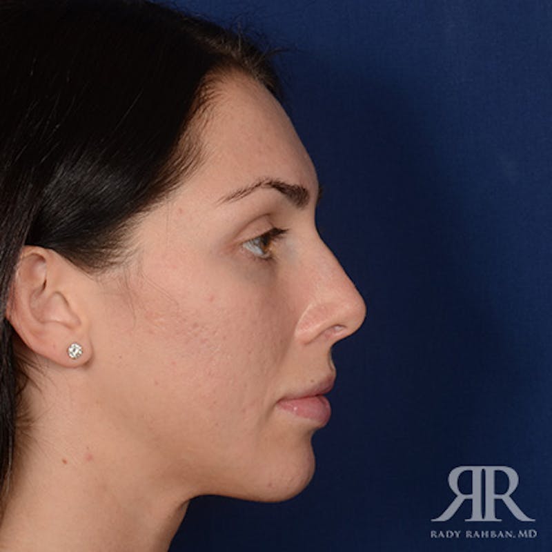 Female Rhinoplasty Before & After Gallery - Patient 622061 - Image 5