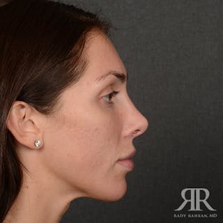Female Rhinoplasty Before & After Gallery - Patient 622061 - Image 6
