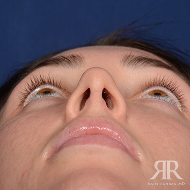 Female Rhinoplasty Before & After Gallery - Patient 622061 - Image 7
