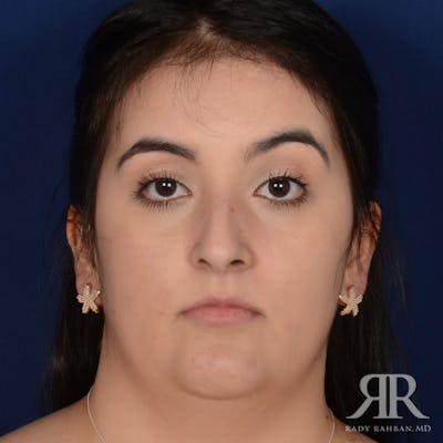 Female Rhinoplasty Before & After Gallery - Patient 277145 - Image 1