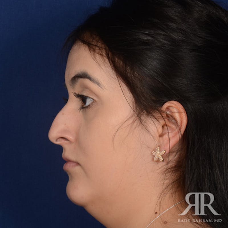 Female Rhinoplasty Before & After Gallery - Patient 277145 - Image 5