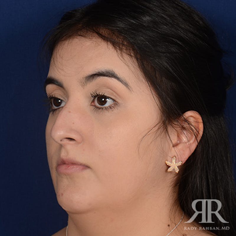 Female Rhinoplasty Before & After Gallery - Patient 277145 - Image 3