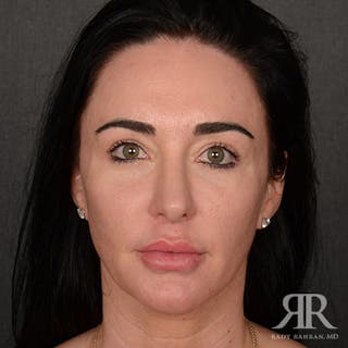 Female Rhinoplasty Before & After Gallery - Patient 255539 - Image 2