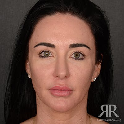 Female Rhinoplasty Before & After Gallery - Patient 255539 - Image 2