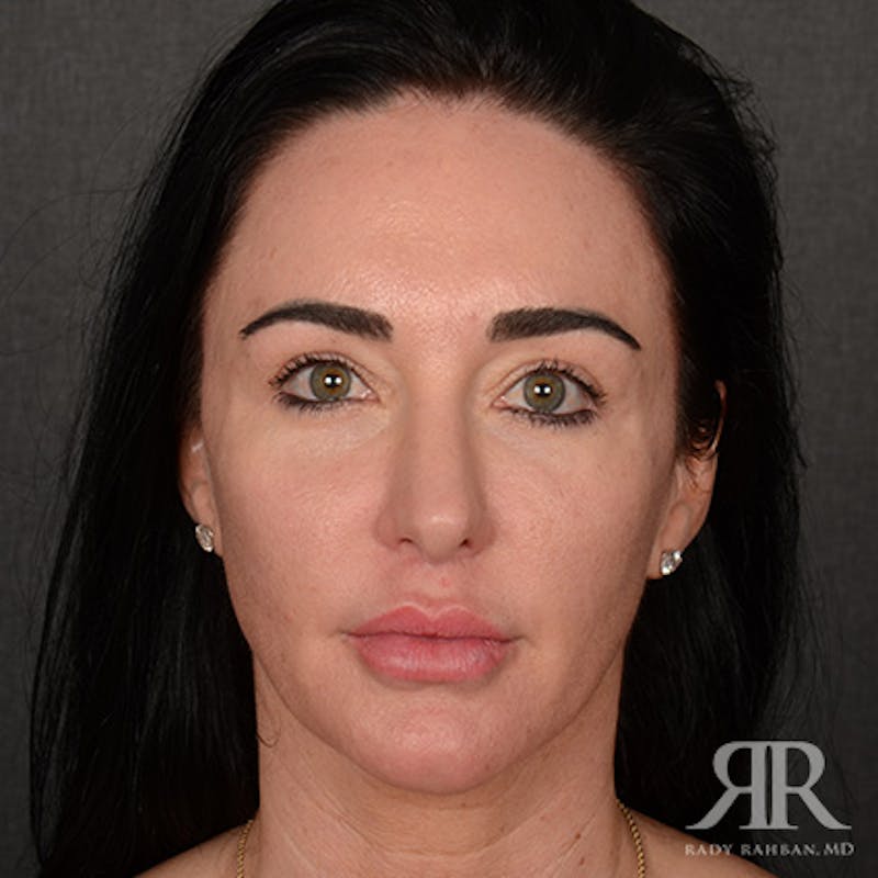 Female Rhinoplasty Before & After Gallery - Patient 255539 - Image 2