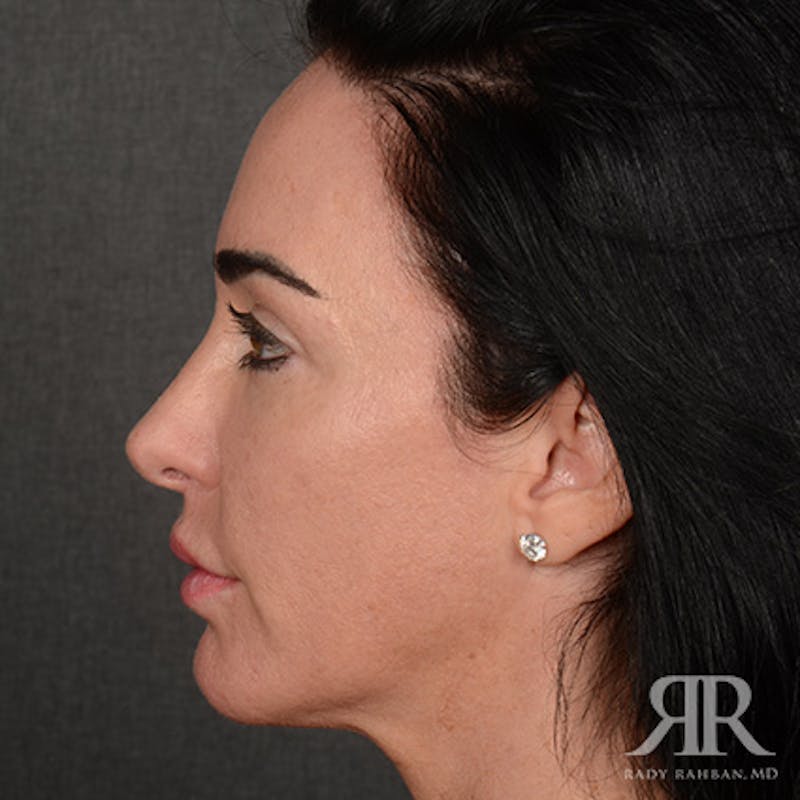 Female Rhinoplasty Before & After Gallery - Patient 255539 - Image 6
