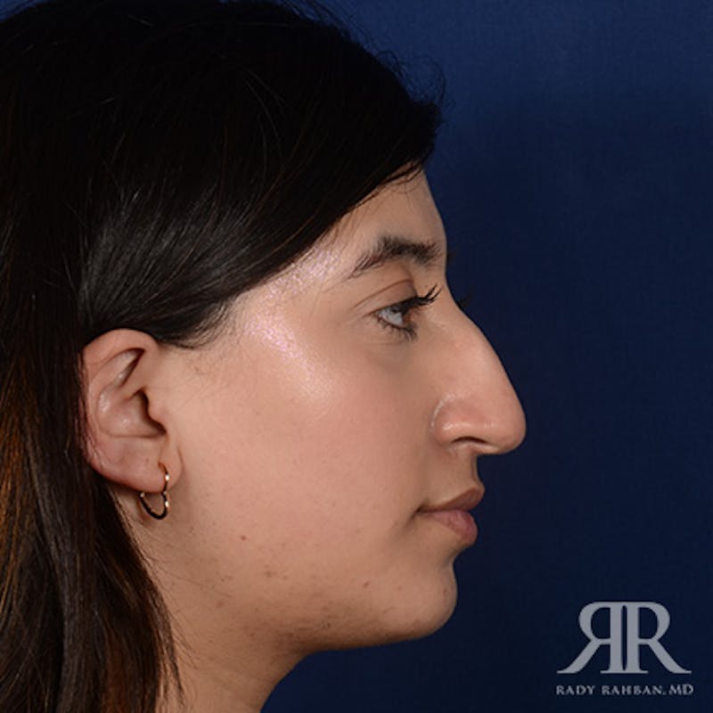 Female Rhinoplasty Before & After Gallery - Patient 187268 - Image 5
