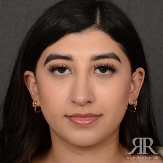 Female Rhinoplasty Before & After Gallery - Patient 187268 - Image 2