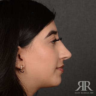 Female Rhinoplasty Before & After Gallery - Patient 187268 - Image 6
