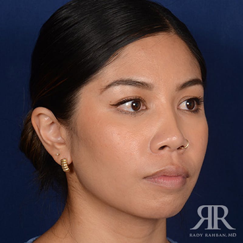 Female Rhinoplasty Before & After Gallery - Patient 428301 - Image 3