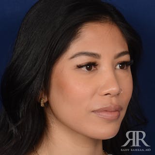 Female Rhinoplasty Before & After Gallery - Patient 428301 - Image 4