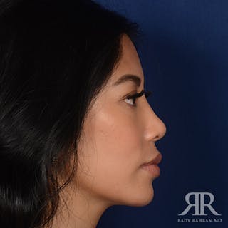 Female Rhinoplasty Before & After Gallery - Patient 428301 - Image 6
