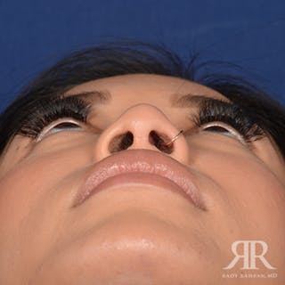 Female Rhinoplasty Before & After Gallery - Patient 428301 - Image 8