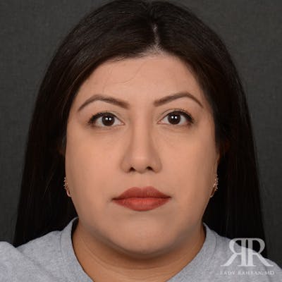Female Rhinoplasty Before & After Gallery - Patient 394425 - Image 2