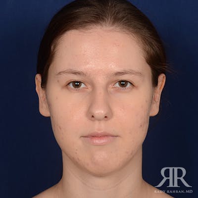 Female Rhinoplasty Before & After Gallery - Patient 342016 - Image 1
