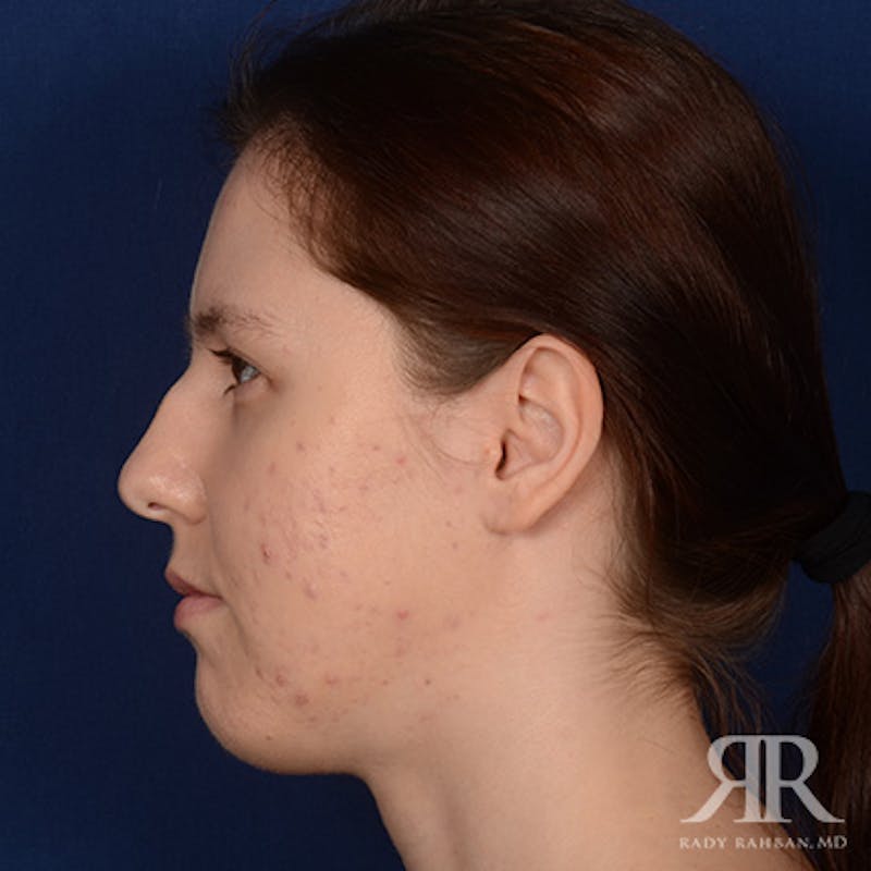 Female Rhinoplasty Before & After Gallery - Patient 342016 - Image 5