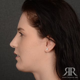 Female Rhinoplasty Before & After Gallery - Patient 342016 - Image 6