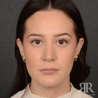 Female Rhinoplasty Before & After Gallery - Patient 302916 - Image 2