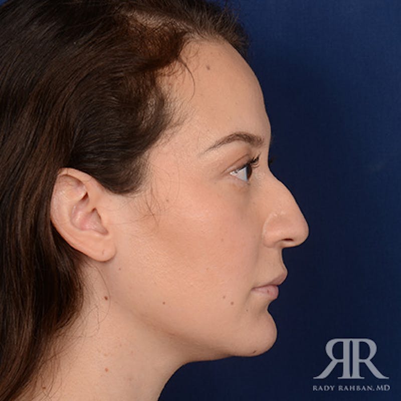 Female Rhinoplasty Before & After Gallery - Patient 302916 - Image 5