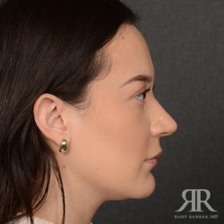 Female Rhinoplasty Before & After Gallery - Patient 302916 - Image 6