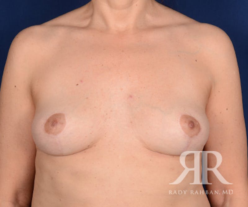 Breast Implant Removal Before & After Gallery - Patient 884570 - Image 2