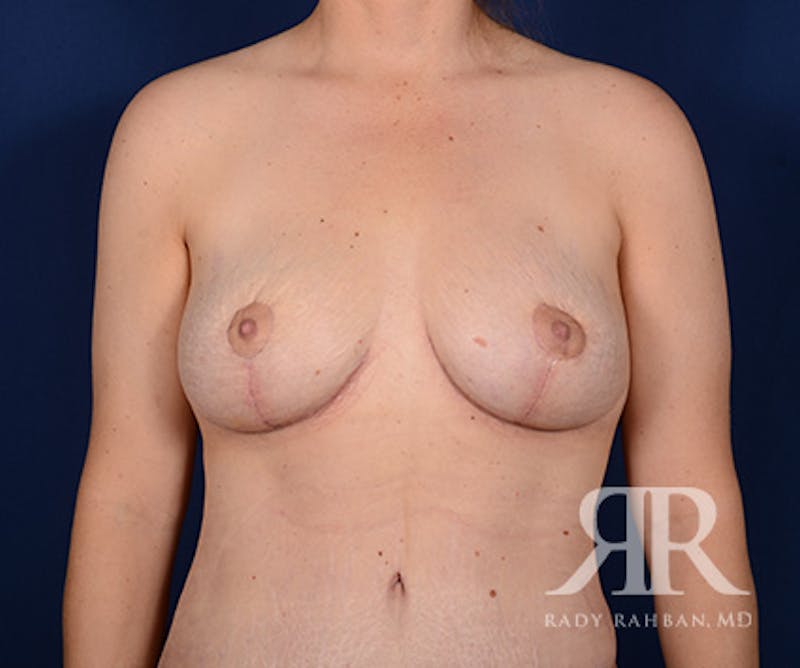 Breast Implant Removal Before & After Gallery - Patient 307493 - Image 2