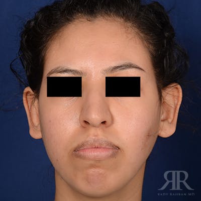 Female Rhinoplasty Before & After Gallery - Patient 179638 - Image 1